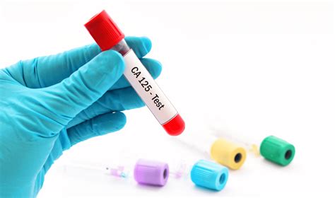 ca 125 blood test bottle colour|ca 125 blood test prognosis.